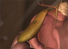 胆嚢3Dイメージ