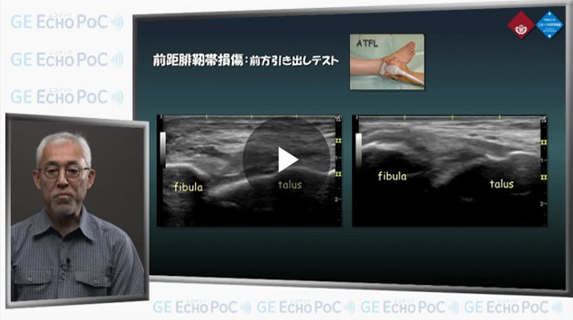整形外科の動画一覧 診療科目別動画 Ge Echo Poc エコポック Geヘルスケア ジャパン